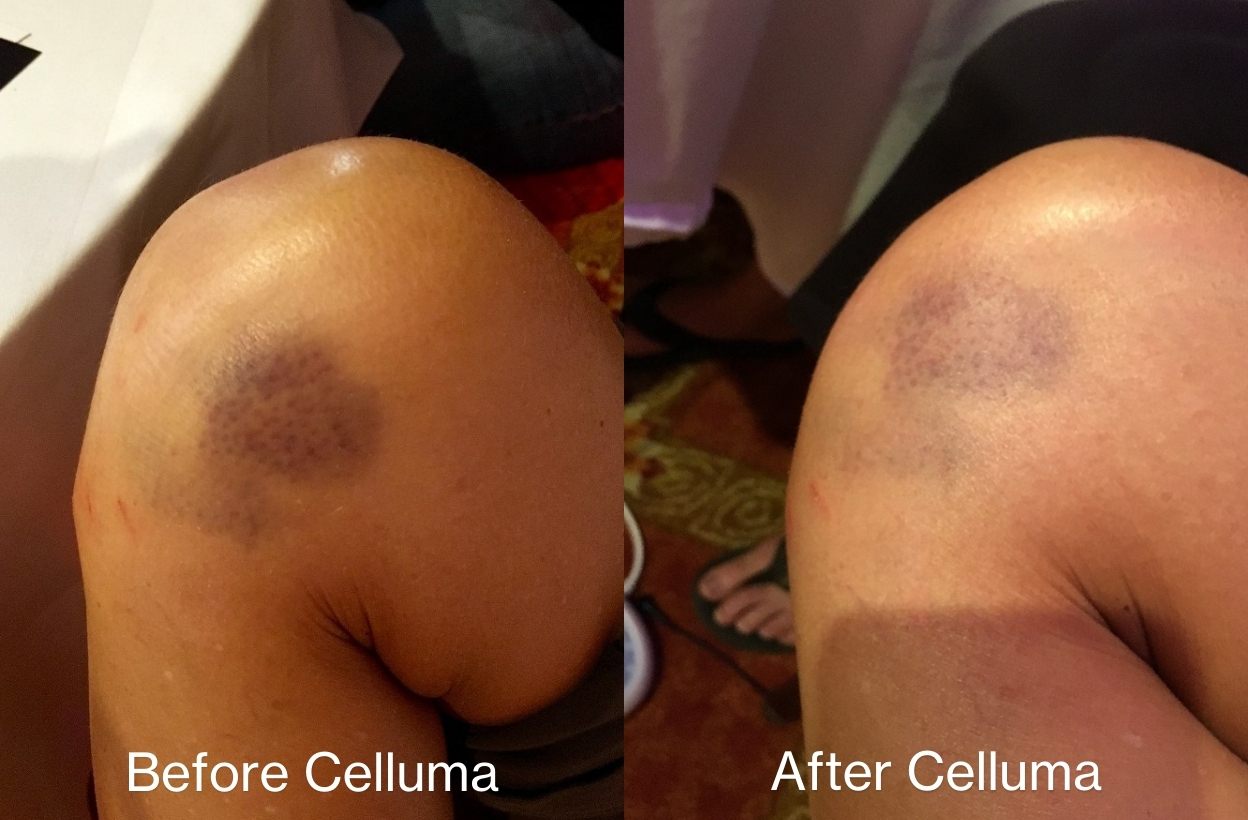 Before and after views of a knee following a light therapy session