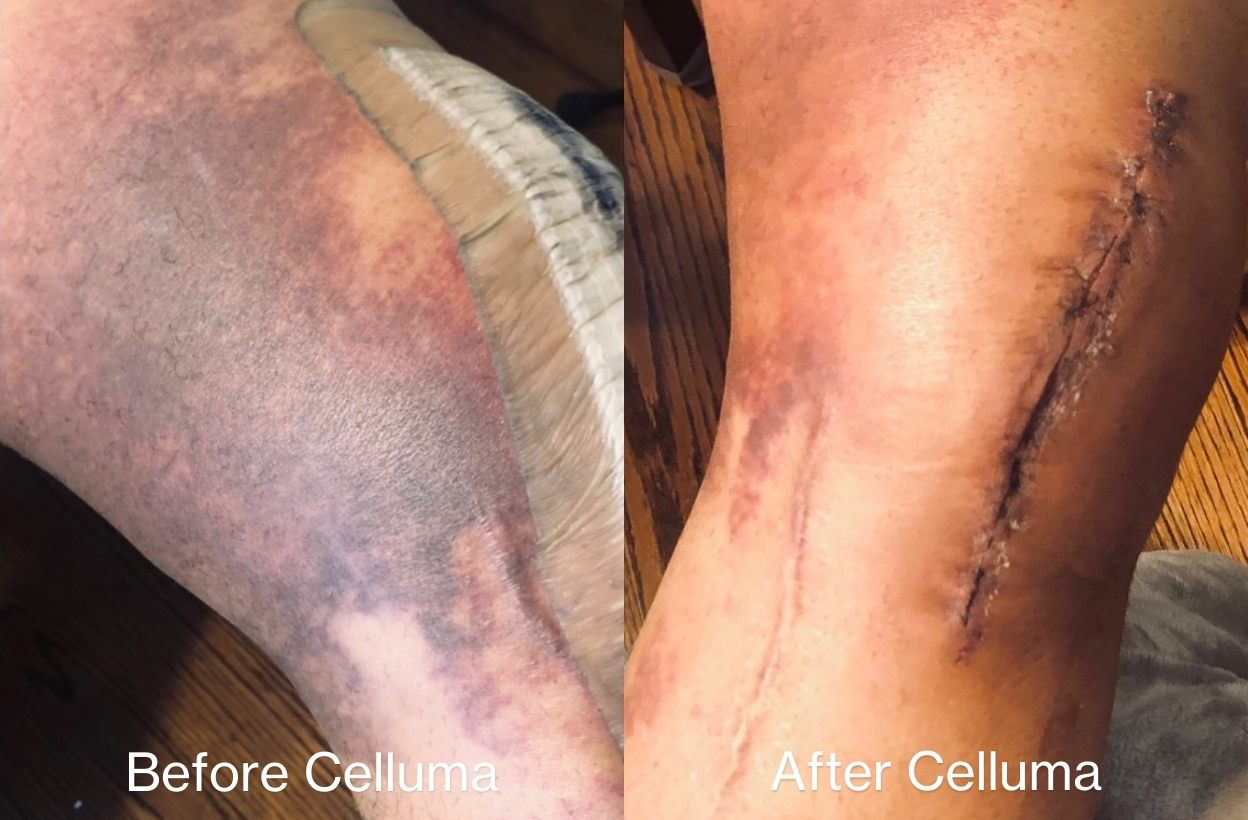 Before and after views of a leg during a light therapy recovery routine